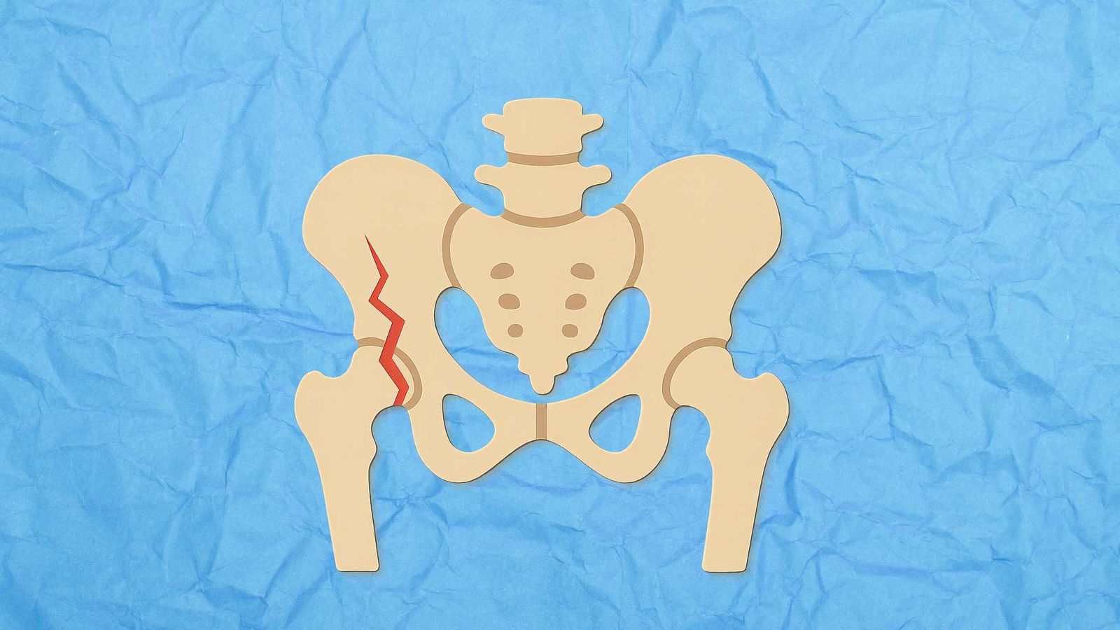 Knoglebrud? Skru op for helingen med hydrogenvand og inhalation Når kroppen skal hele en brækket eller en revne i en knogle, kræver det et enormt samarbejde mellem celler, signalstoffer og energi. Knoglevævet skal først stabiliseres, derefter genopbygges, og hele processen afhænger af både god blodforsyning, lav inflammation og stærke celler, der kan dele sig og danne ny knoglematrix.